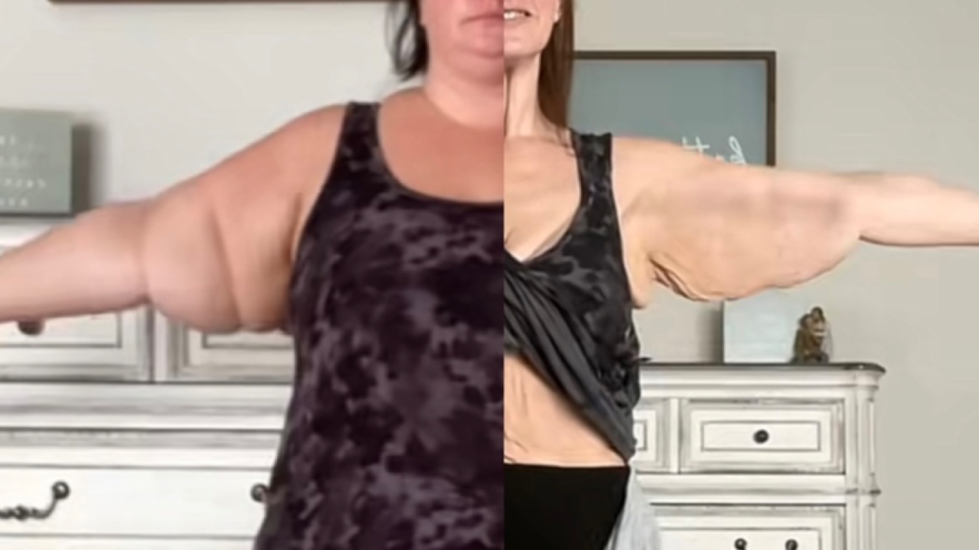 Skin Removal Surgery