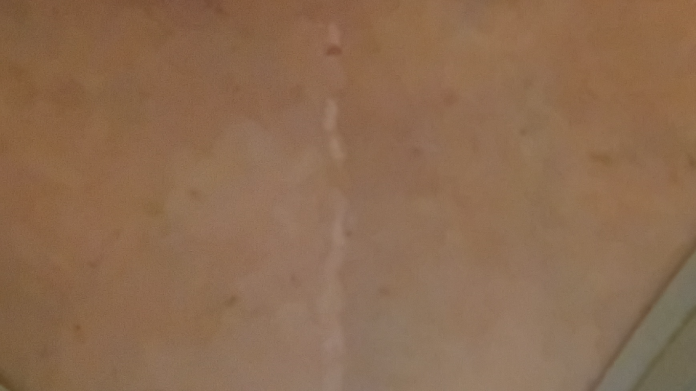 Surgery recovery fund