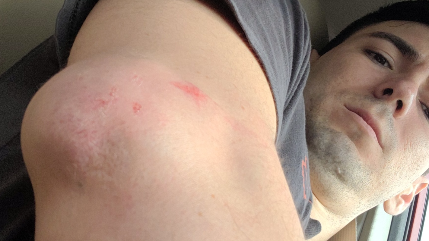 Broke my elbow, lost my job.