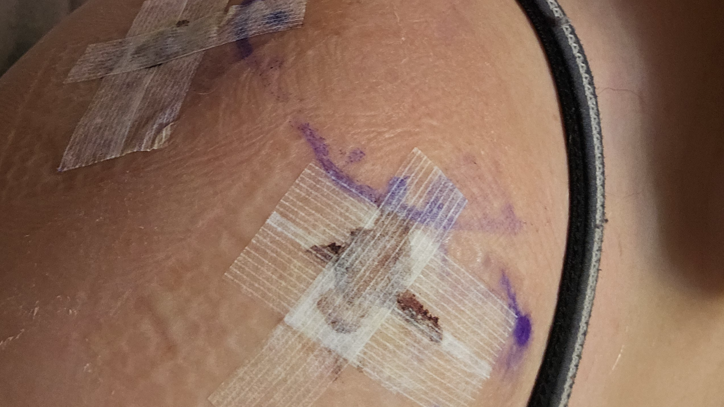 Help Oliver Mom Recover from shoulder surgery