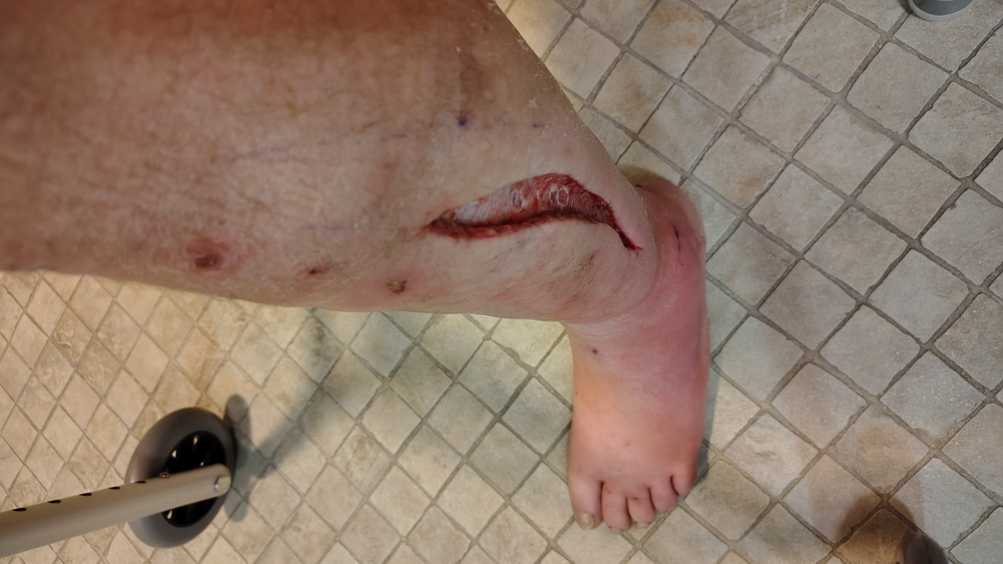 Need a helping him while leg is healing