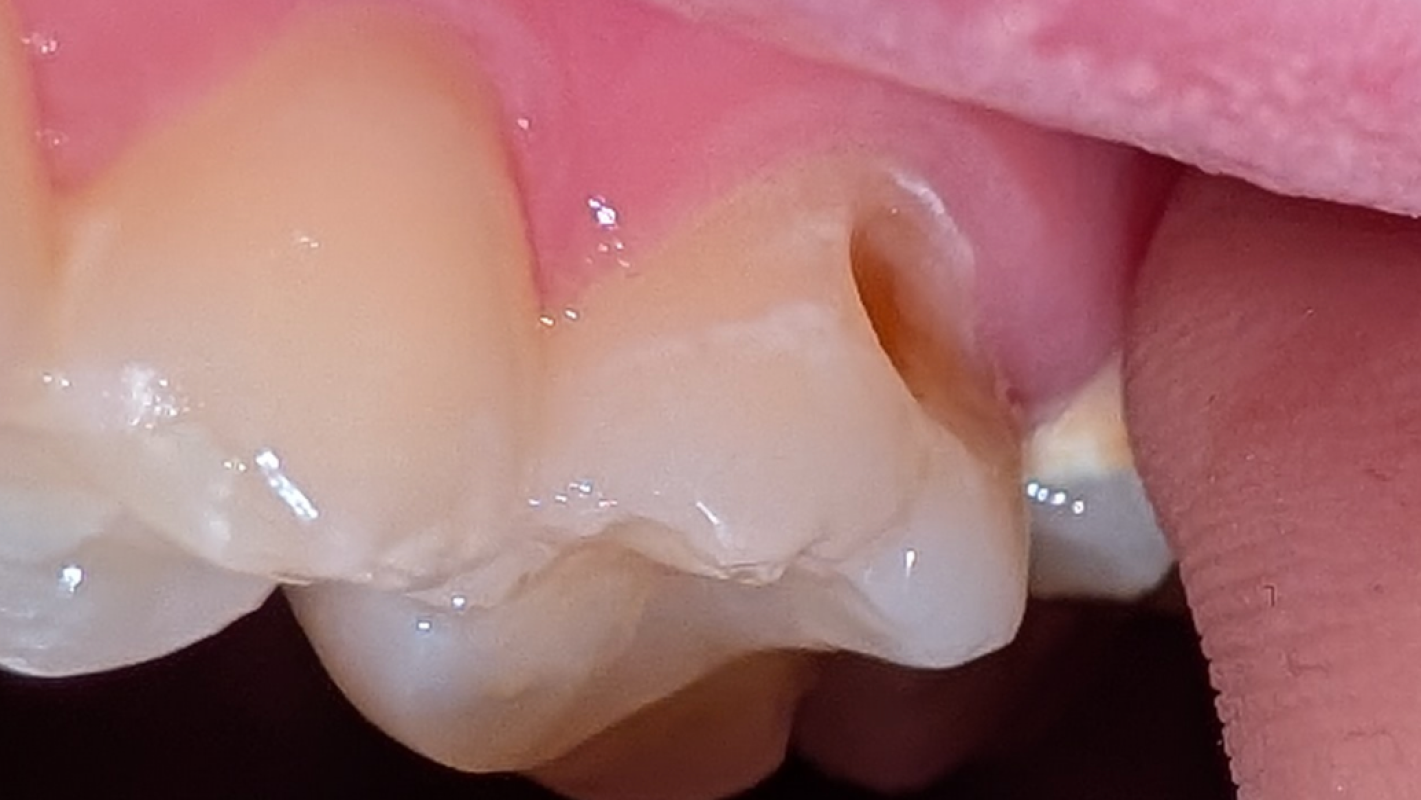 Help August Get Dental Work