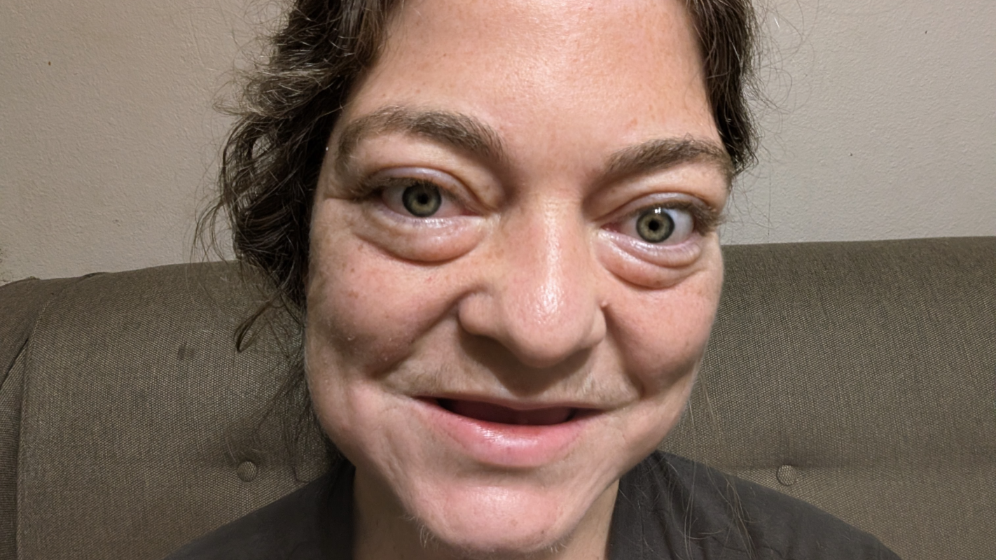 Dentures to help relieve my Pain!