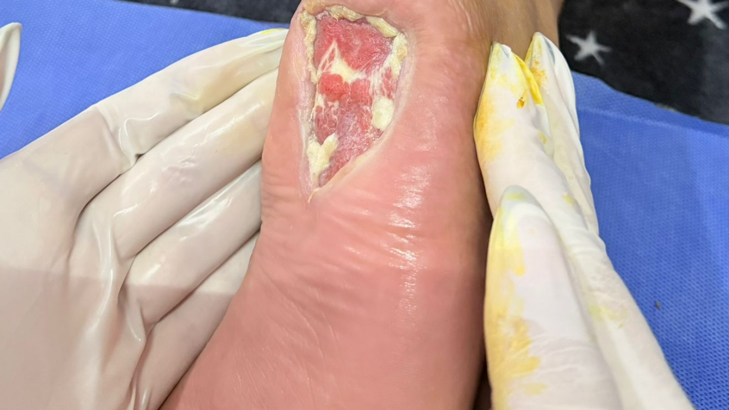 Pie diabetico