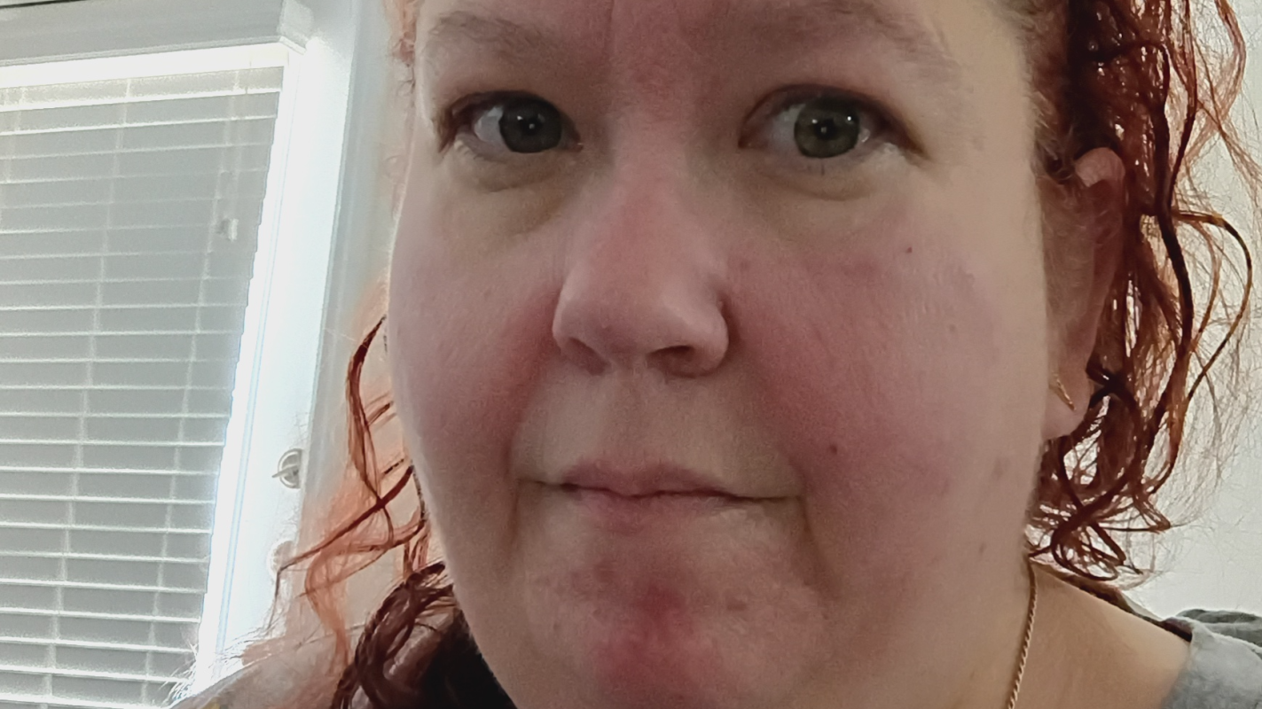 Cataract eye surgery