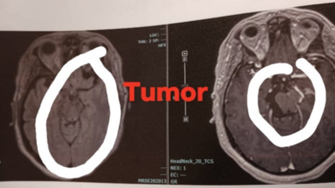 Candace's Brain Surgery
