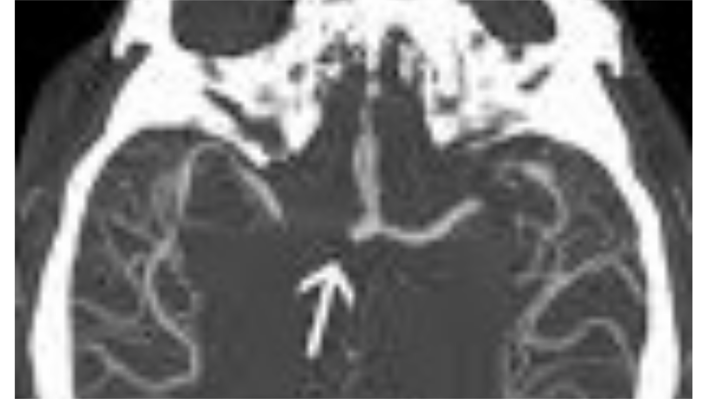 CCG'S BRAIN ANEURYSM HELP PAYING FOR OUT OF POCKET COPAYS, CAB FAIR TO & FROM APPOINTMENTS & OTC MED'S