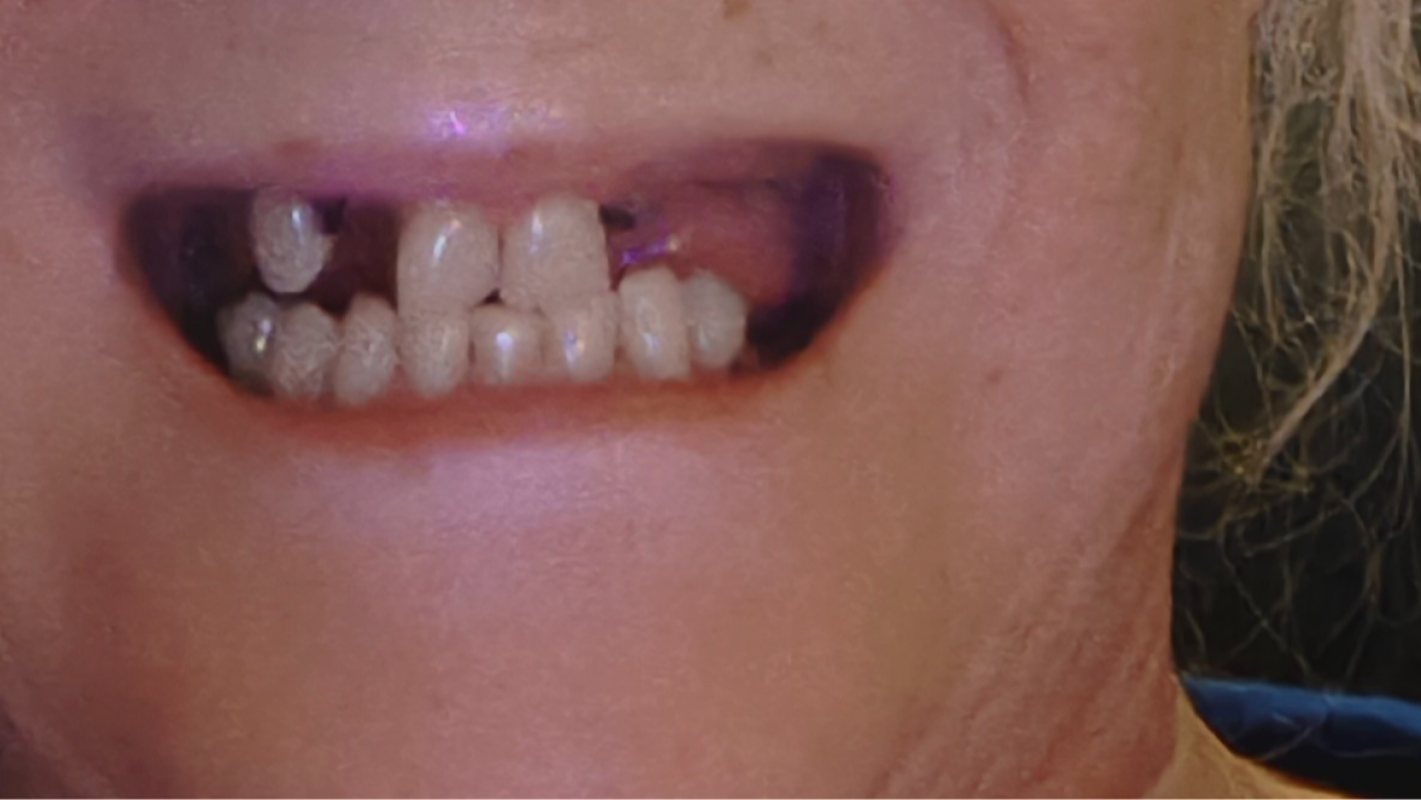 Teeth Implants