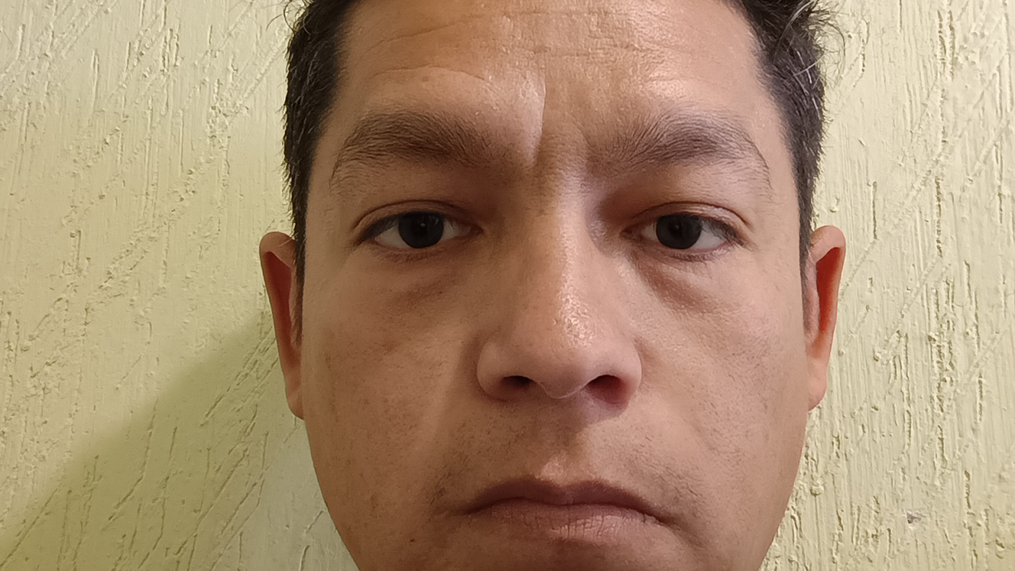 Operación hernia discal