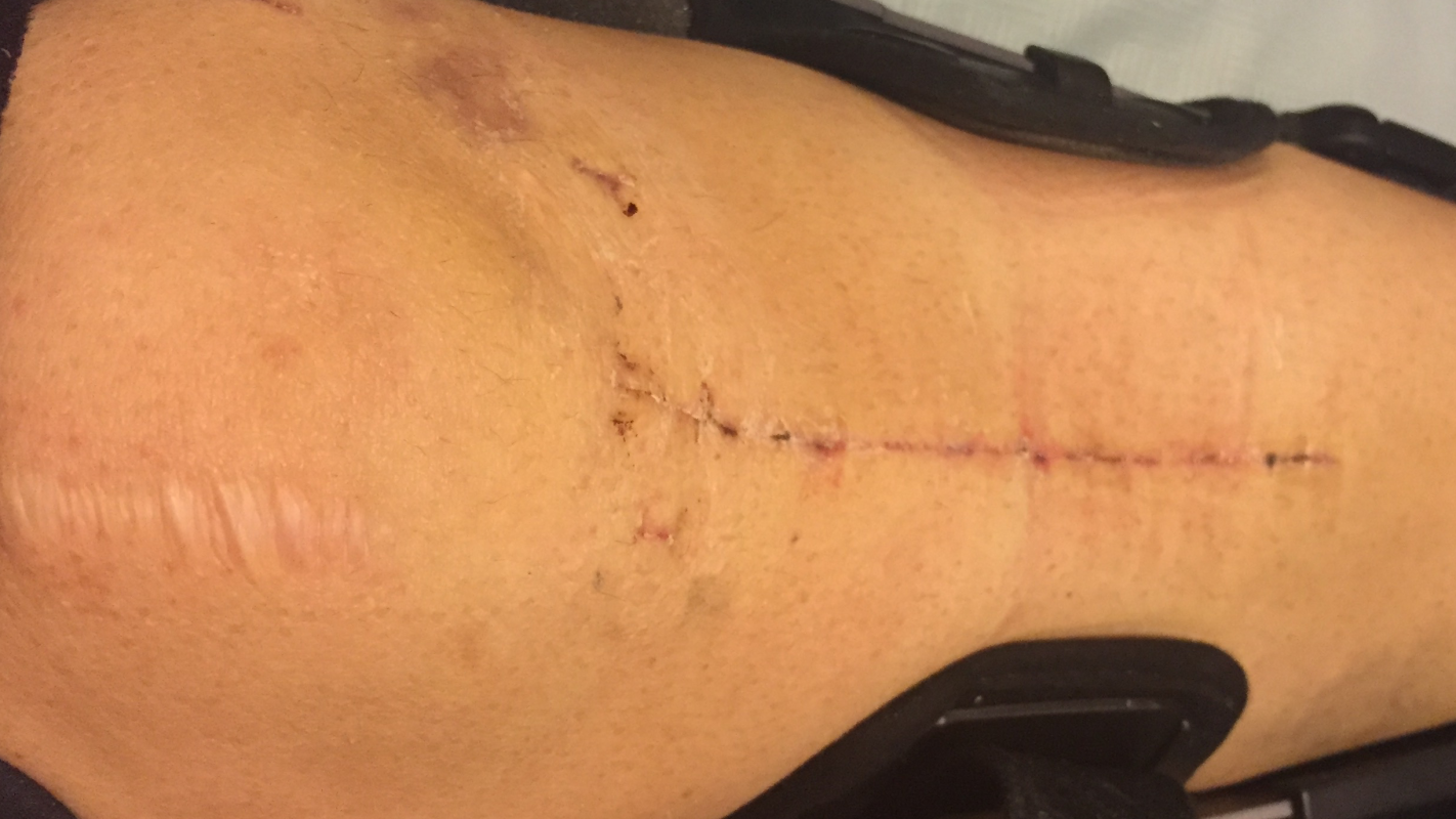 Anne Marie’s Knee Surgery