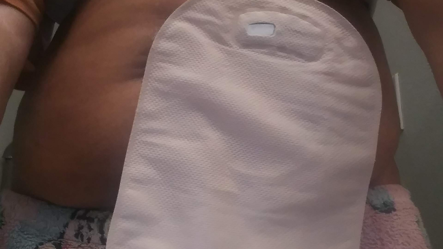“Help Hope Recover After Emergency Colostomy Surgery