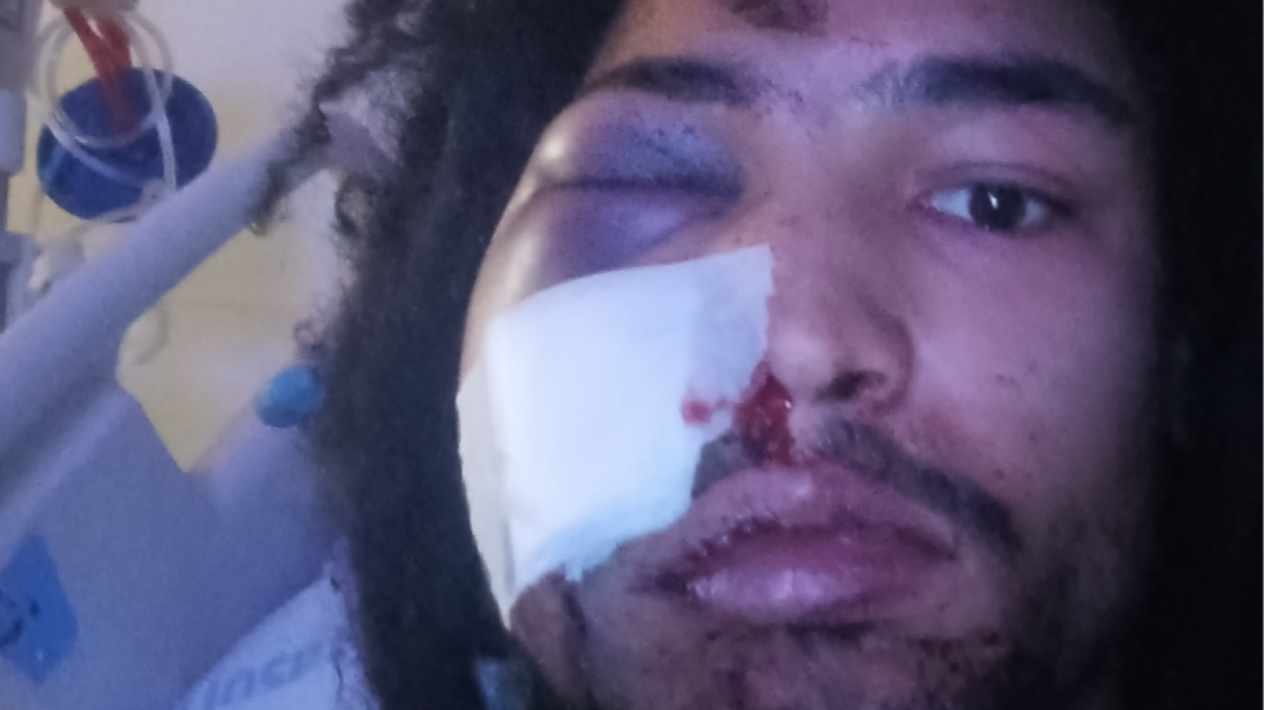 My son's facial surgery after being shot