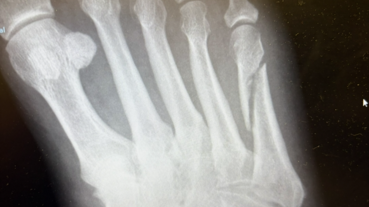 Injuries from Fall at work