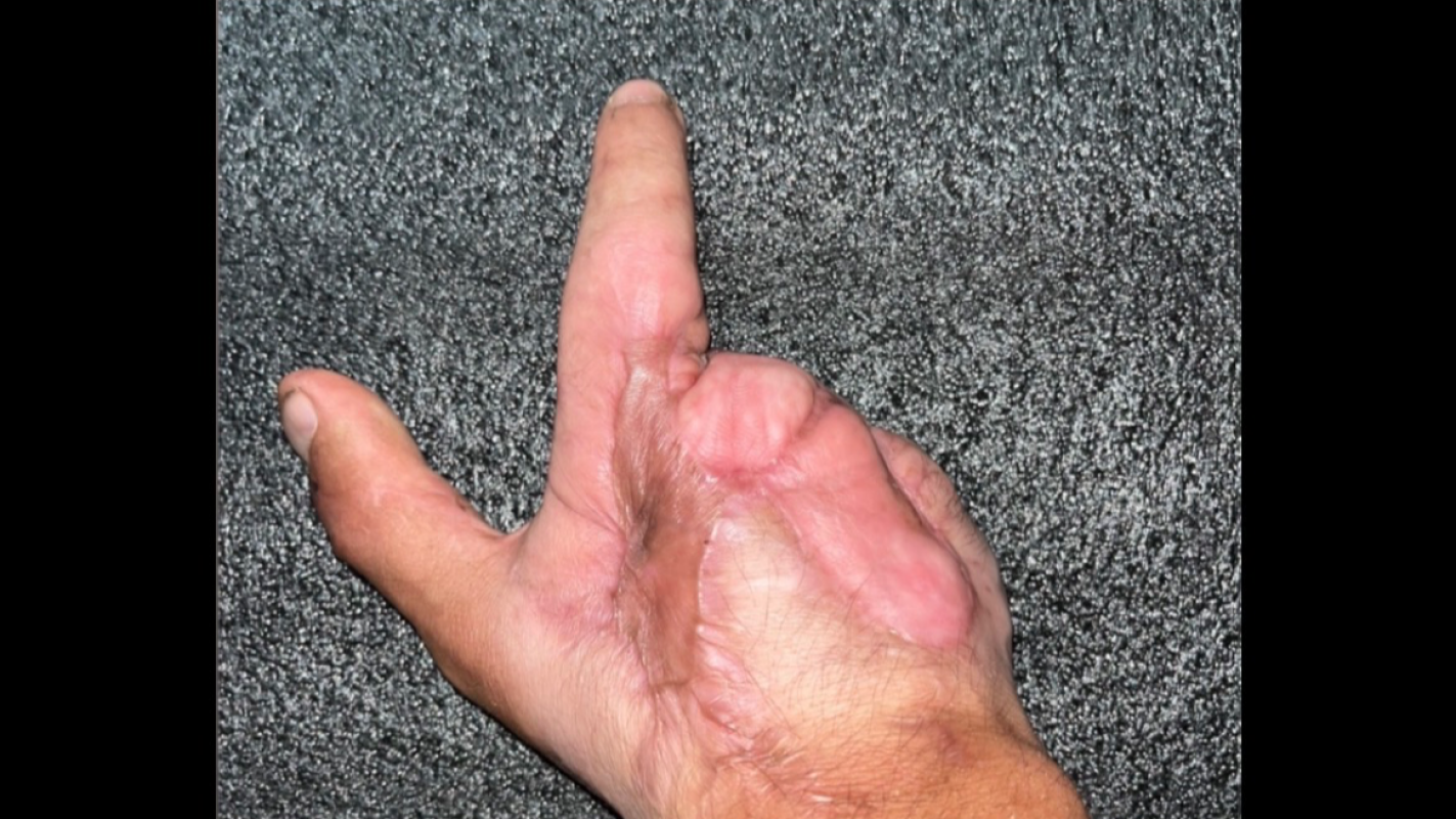 AJ’s Prosthetic Hand