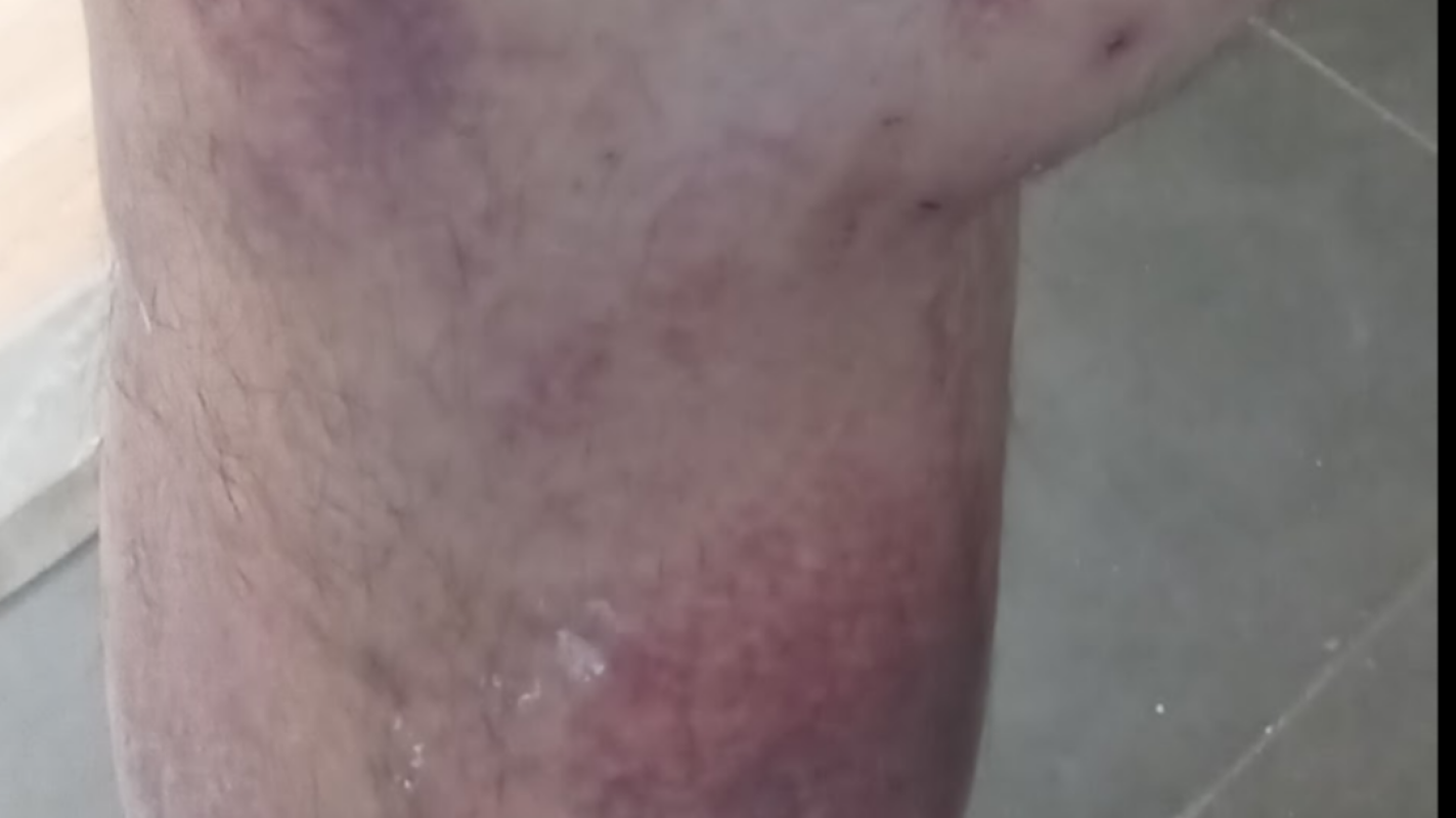 ICE Assault Help Me Survive