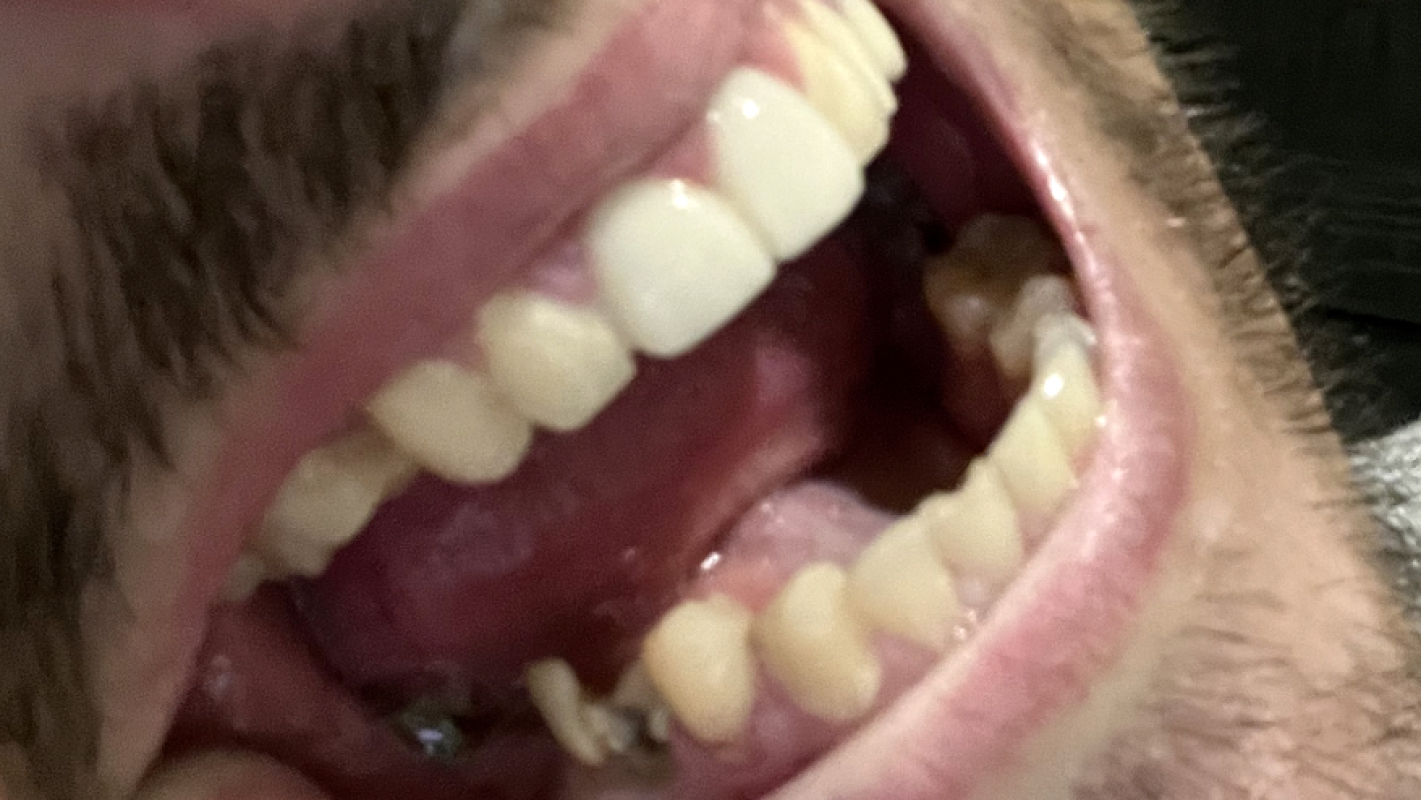 Full Mouth Dental Restoration