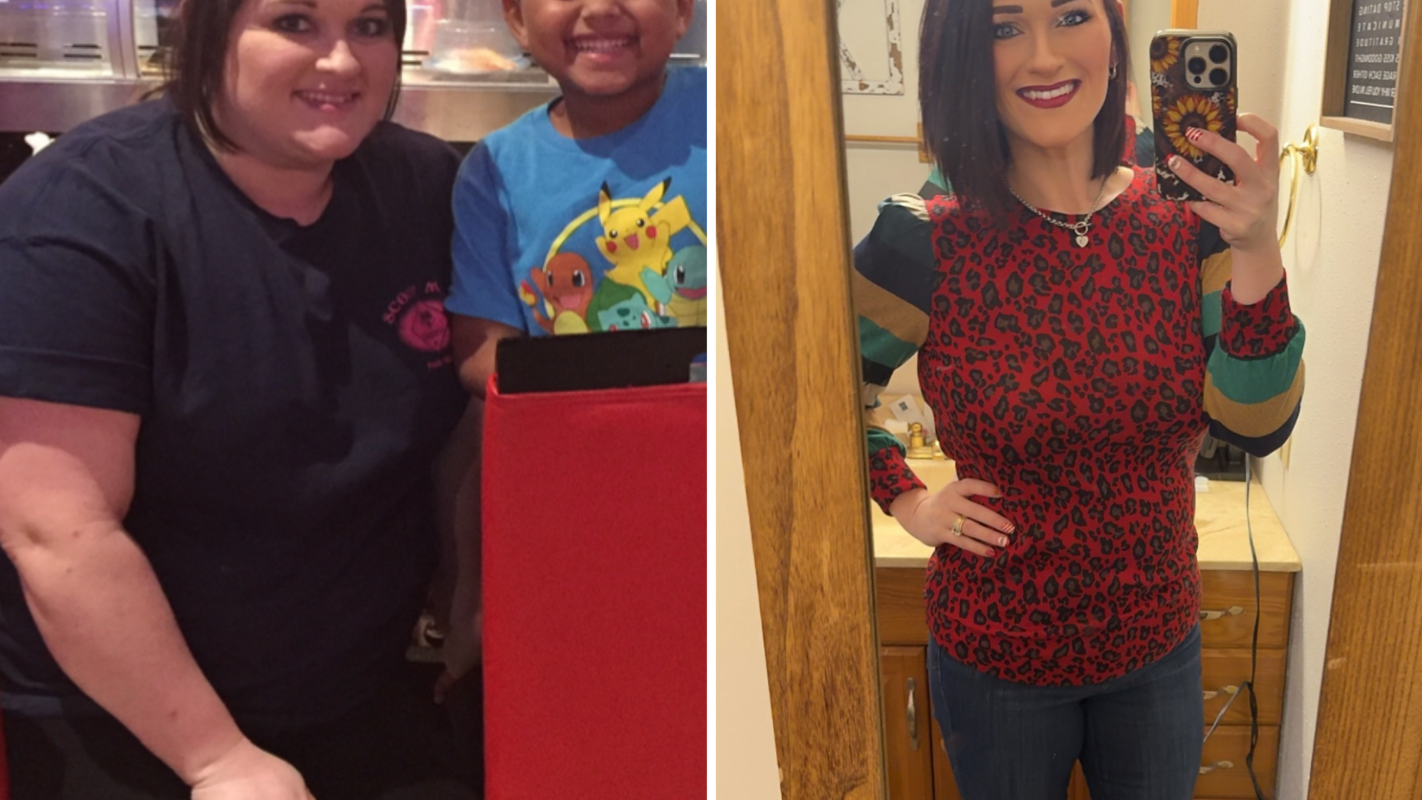 Post Massive Weightloss Skin Removal