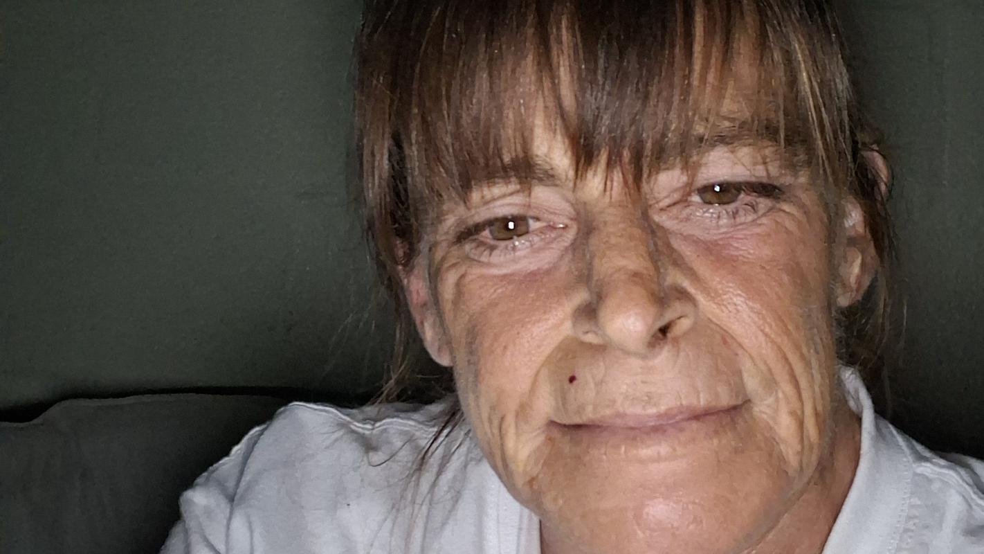 Kidney transplant and facial reconstruction from burn scars