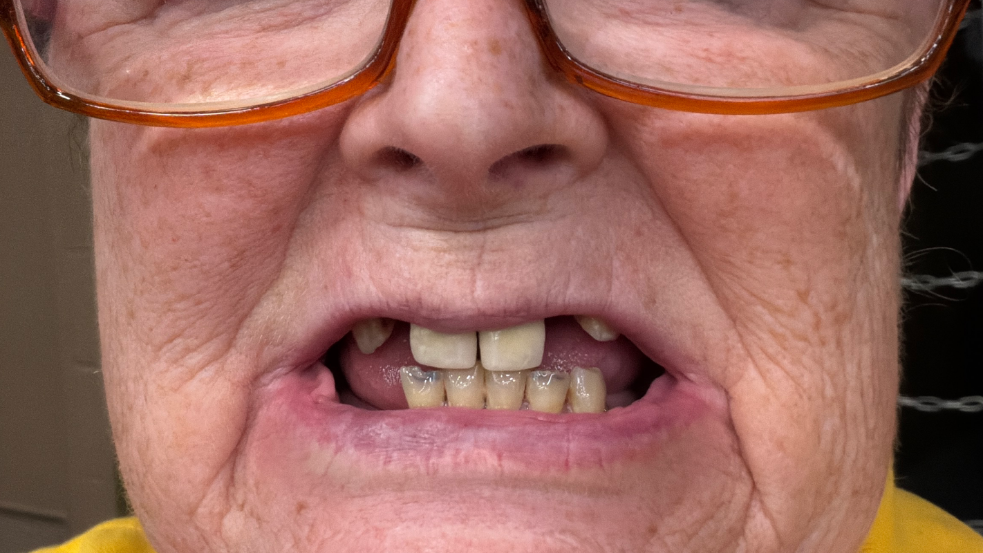 All on four implants