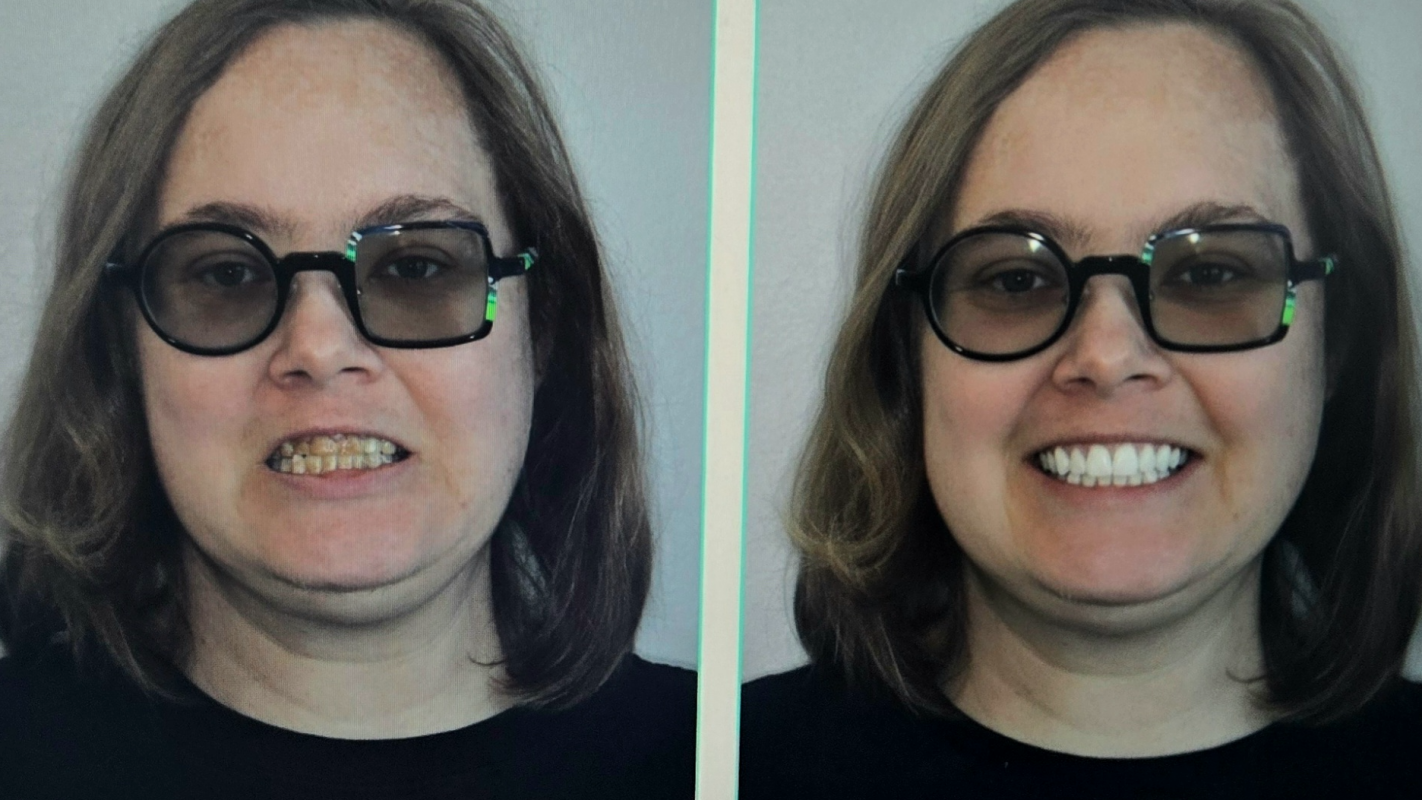 Full Mouth Reconstruction