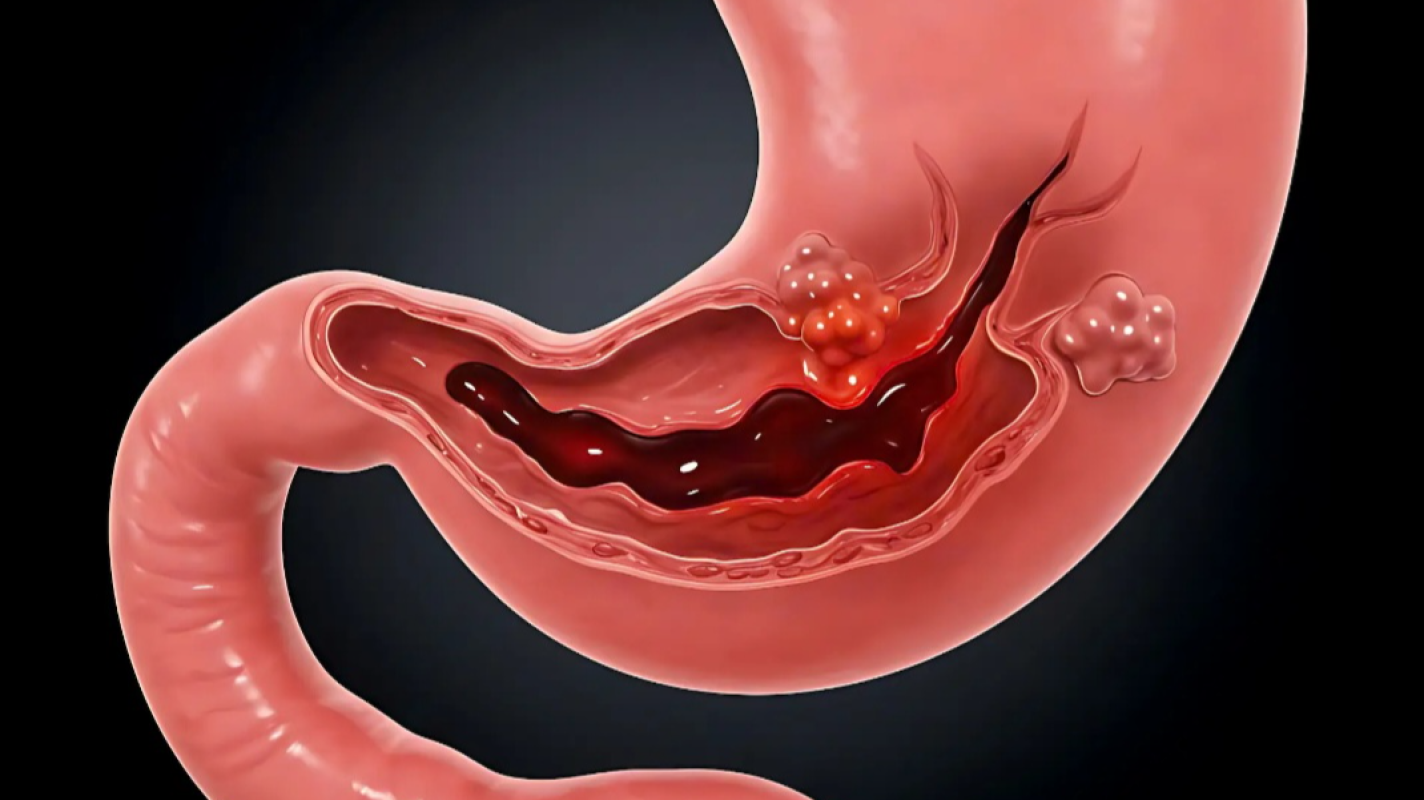 Internal bleeding stomach surgery