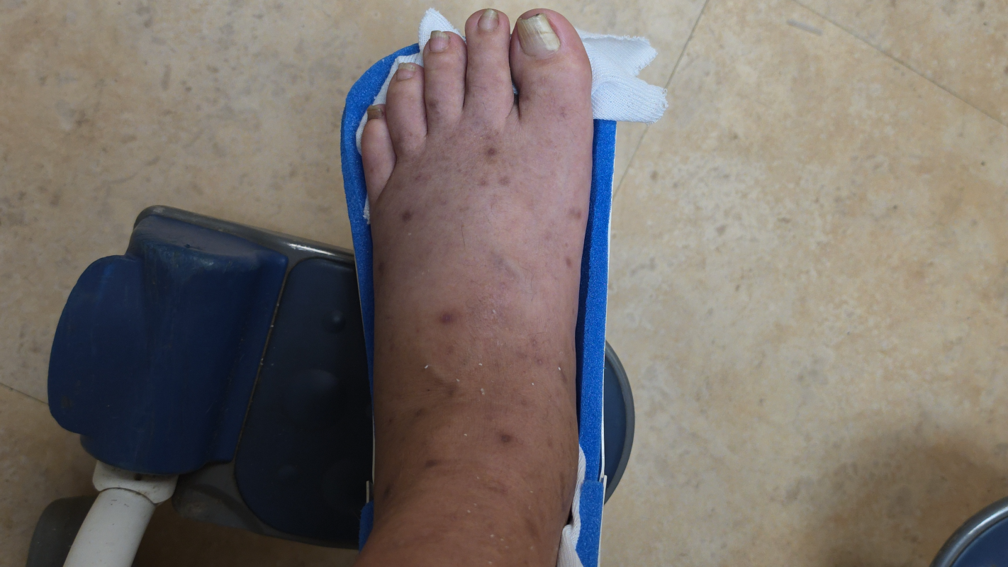Foot surgery