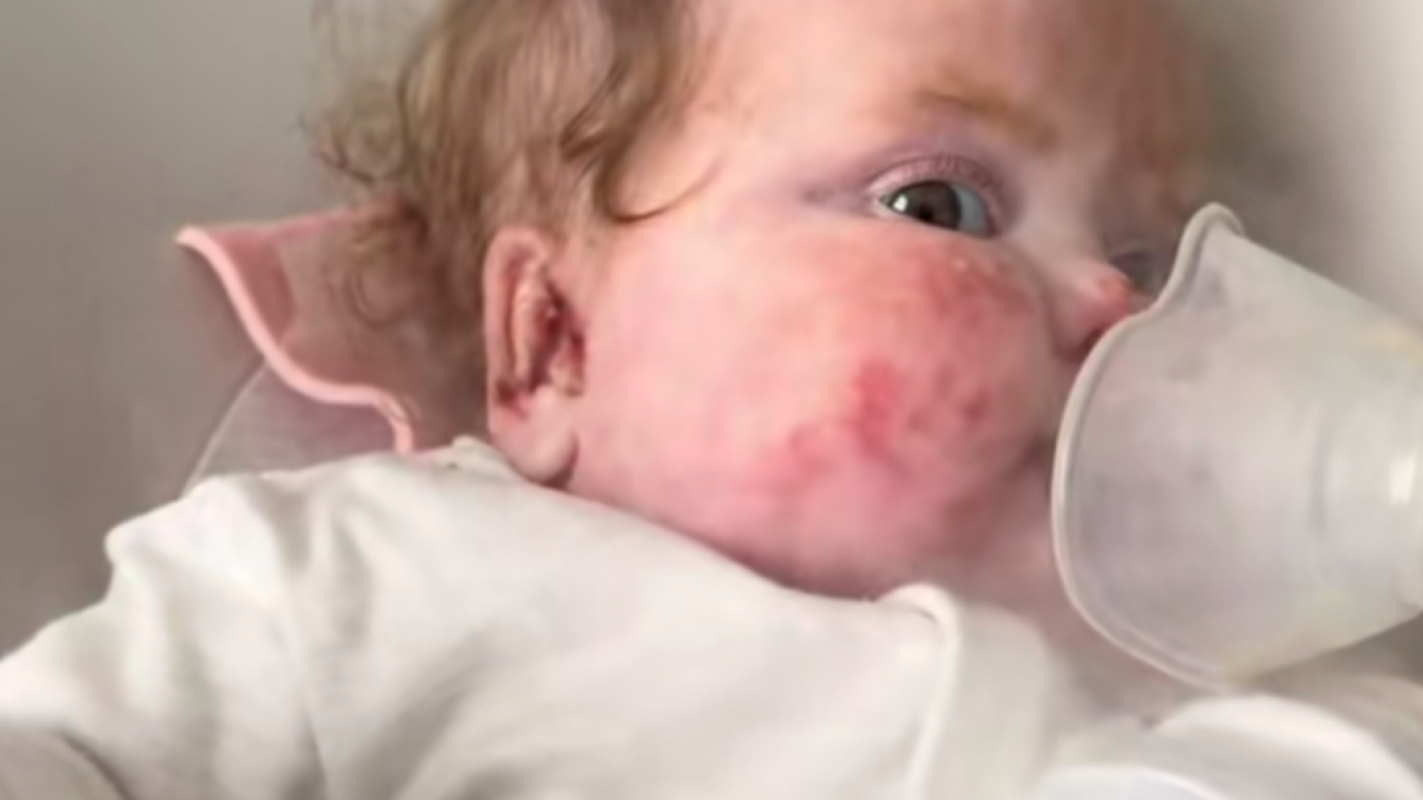 Support Baby Daisy's Fight Against EB