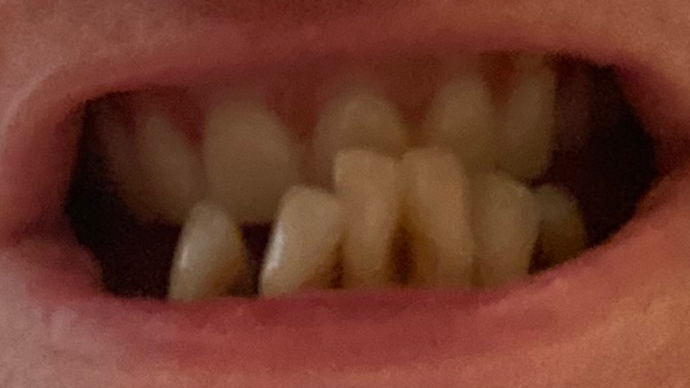 new implants dentures and implants post needed now