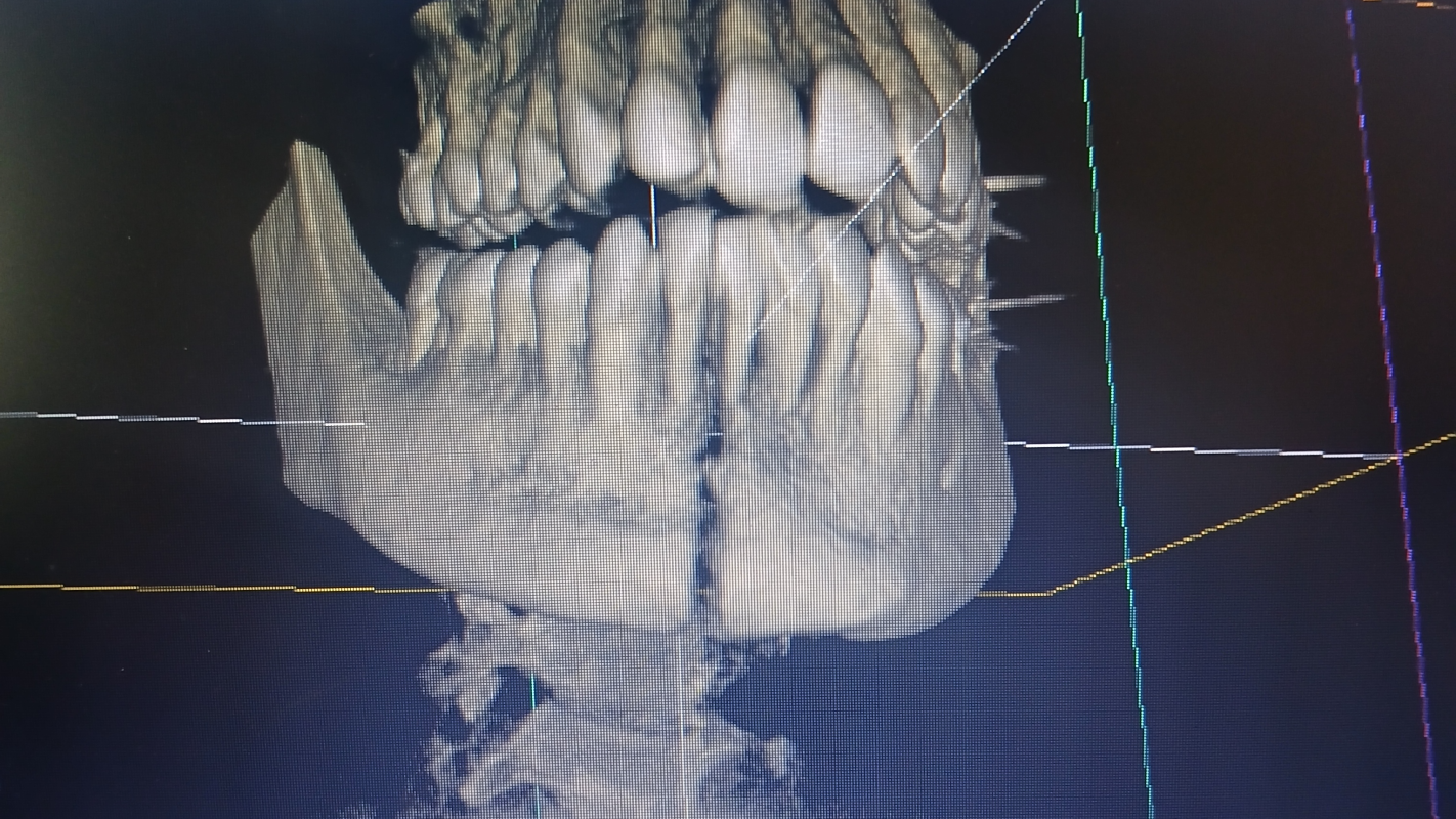 Financial Support for Daniel's Recovery After Jaw Injury