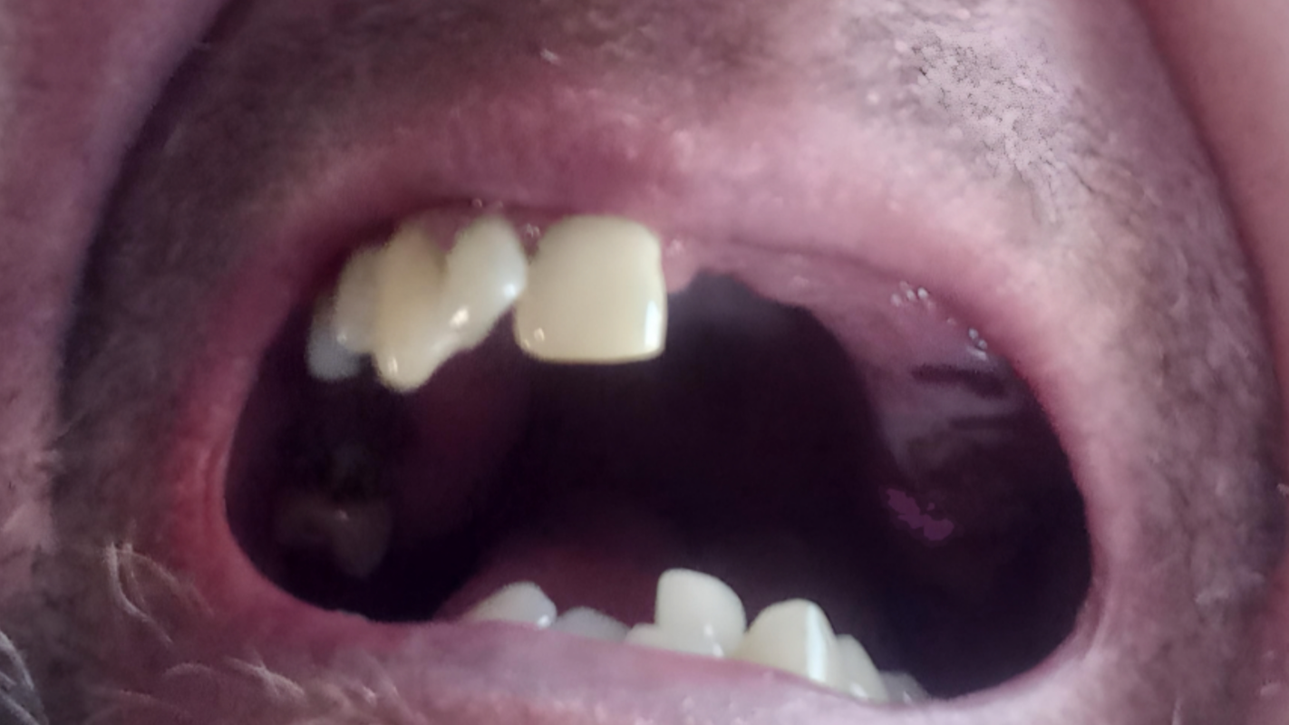 Need Teeth Implants