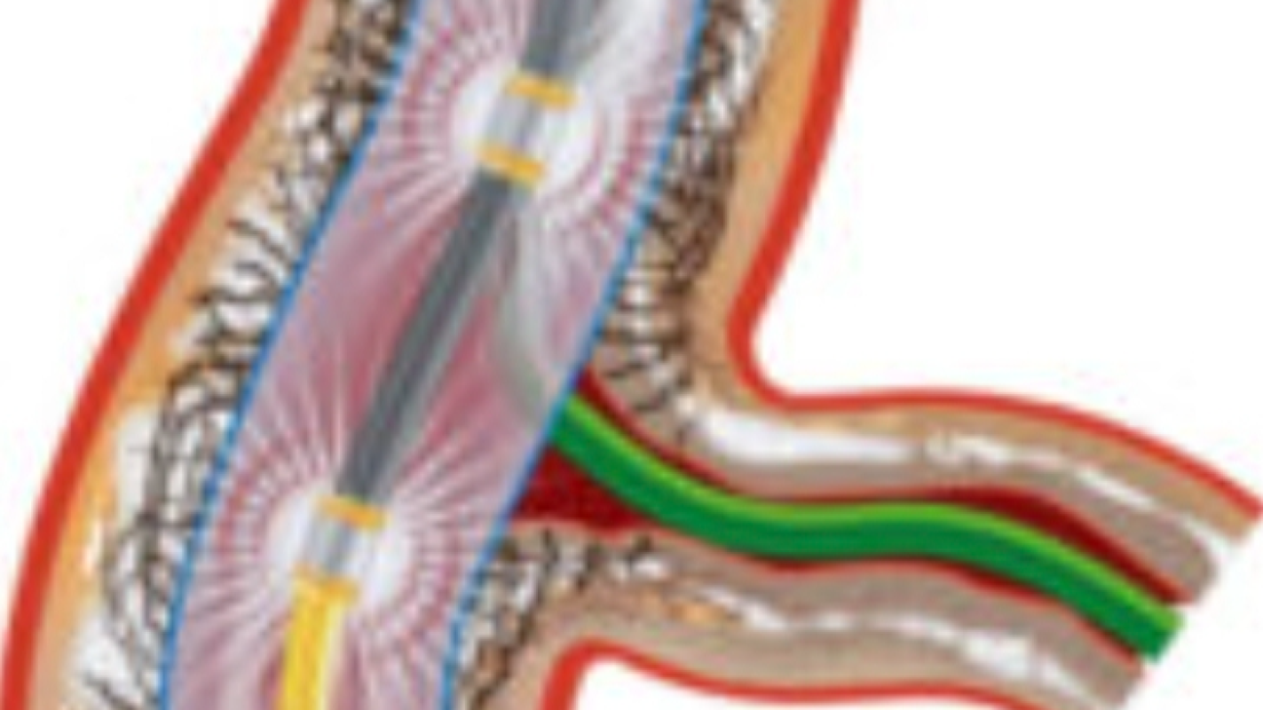 Help my best friend's sister get her heart procedure