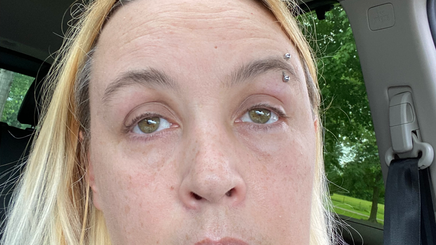 Myositis help relief