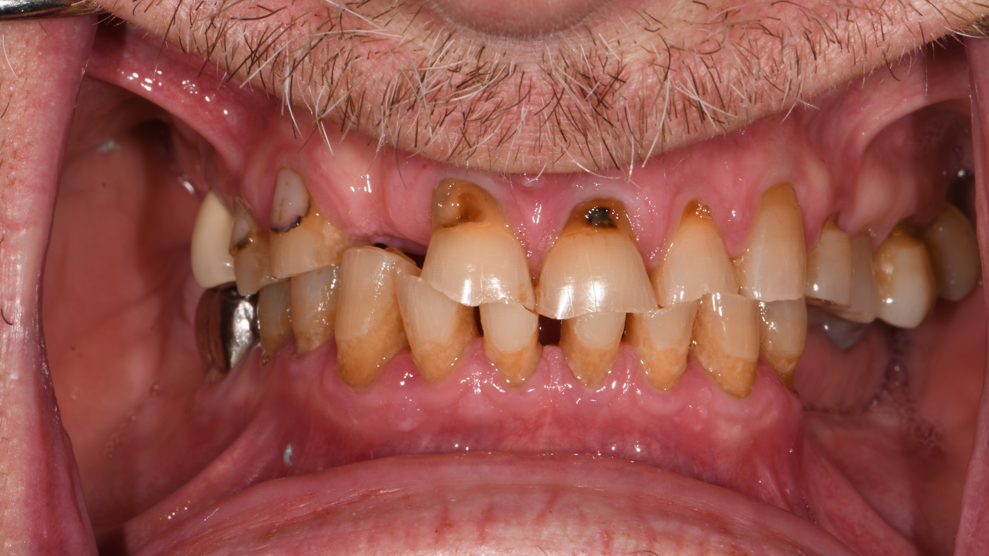 Complete oral reconstruction...and the ability to smile/laugh again.
