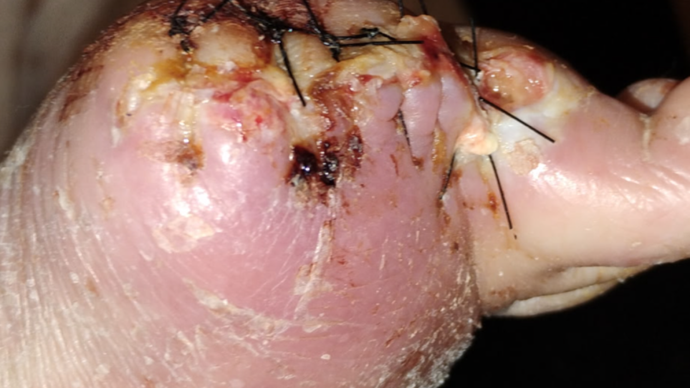 Prosthetic Metal Toe Implant