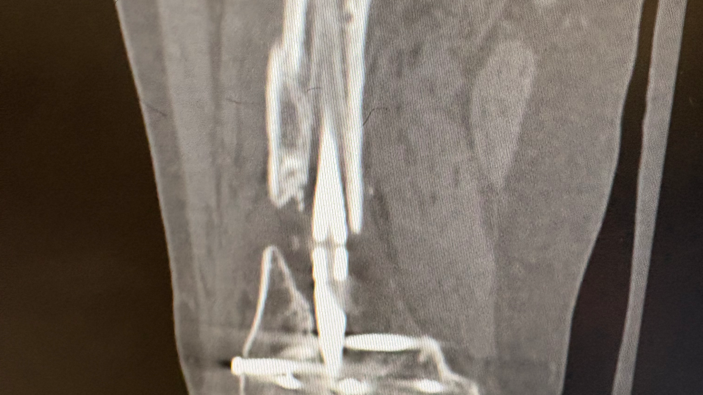 William’s Recovery