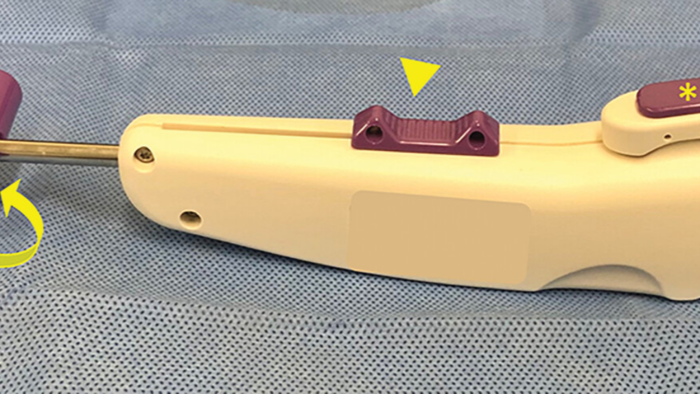 Deb's ultrasound guided carpal tunnel release surgery