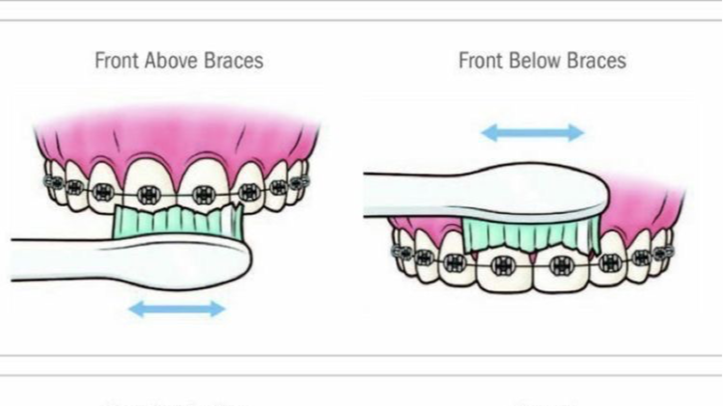 To get braces