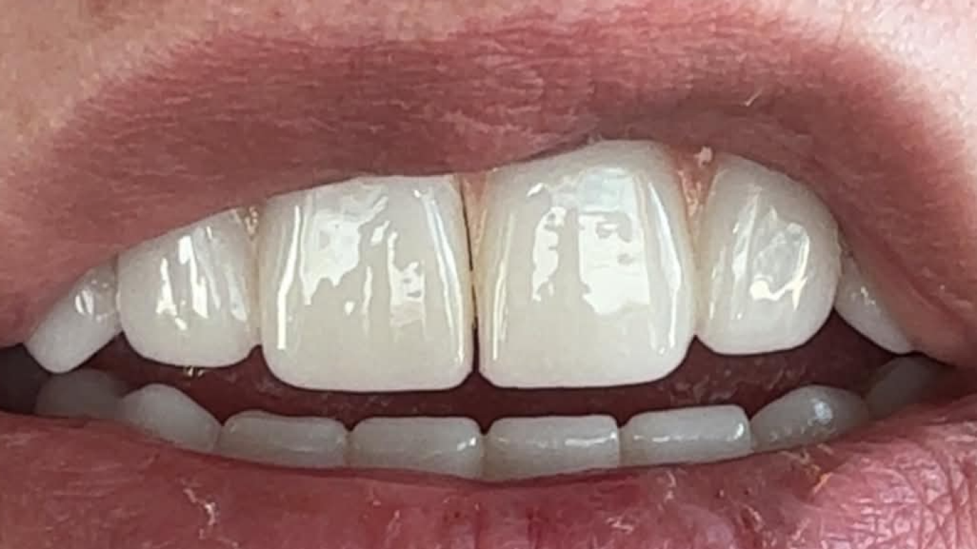 Trip to florida to fix my implant