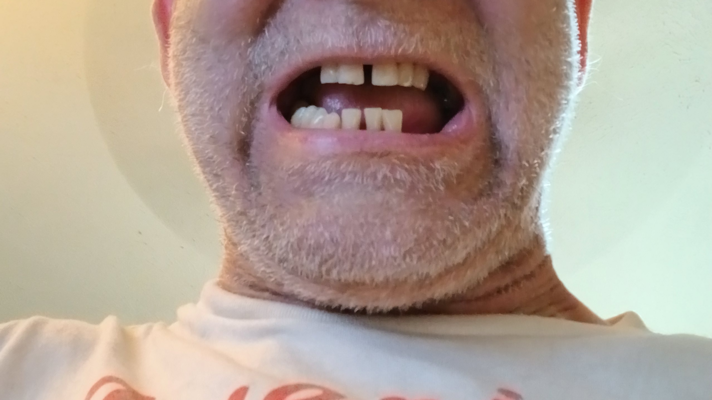tim hilliard dentures