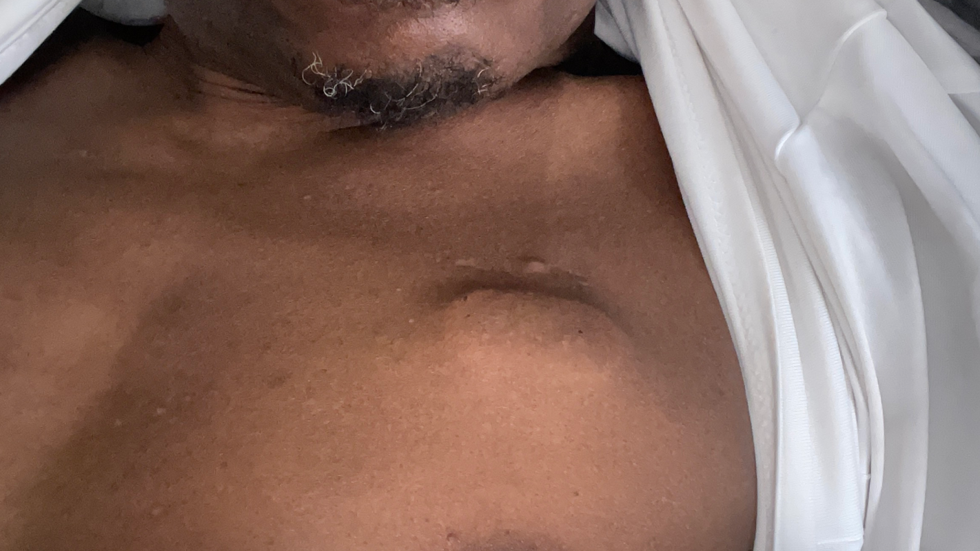Multiple Myeloma