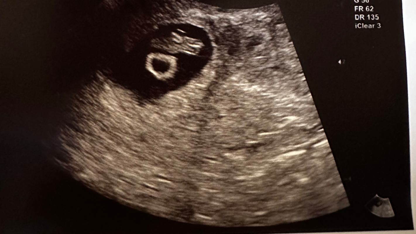 Homeless and Pregnant