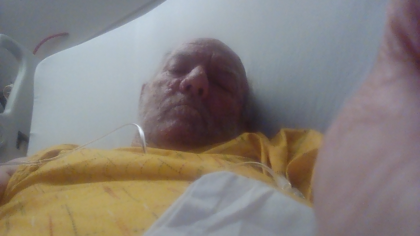 medical bills amputation of leg from bone infection