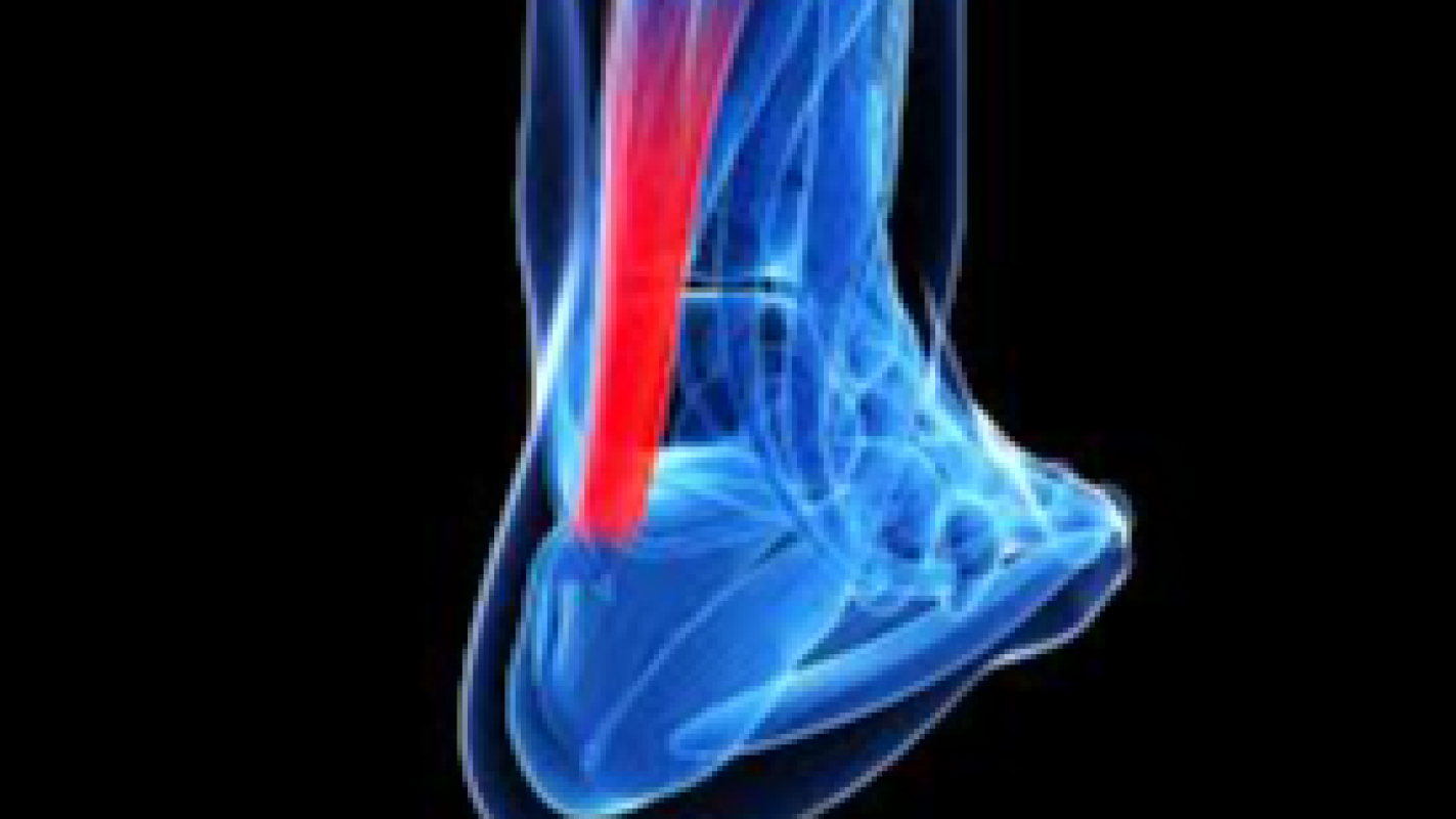 PRP Injections for Achilles