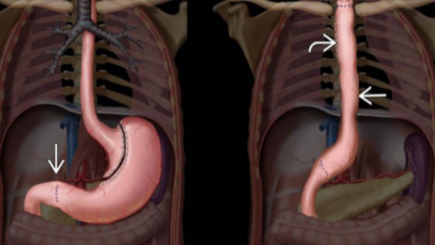 Teacher's Esophagectomy