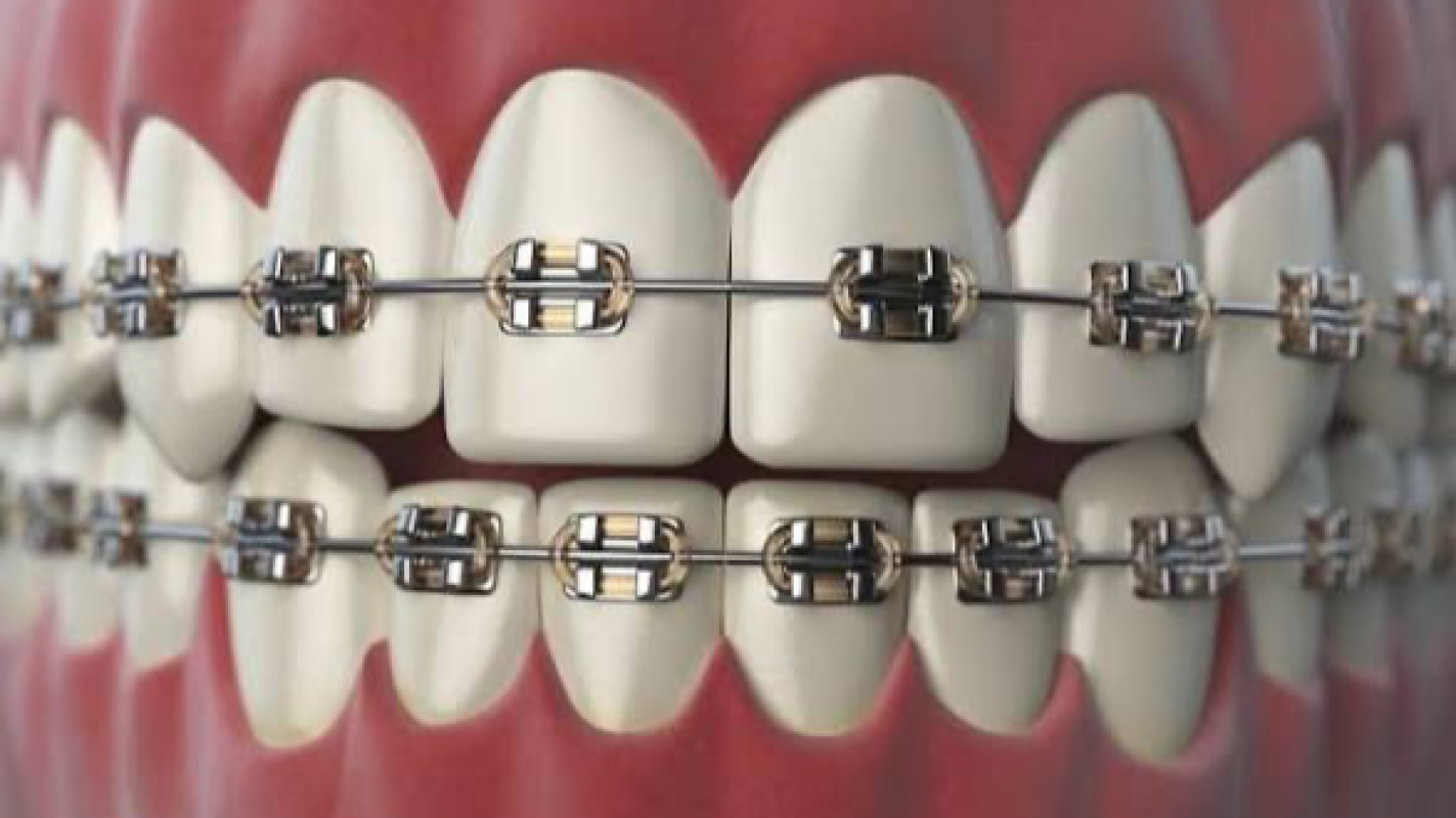 Help with my braces journey