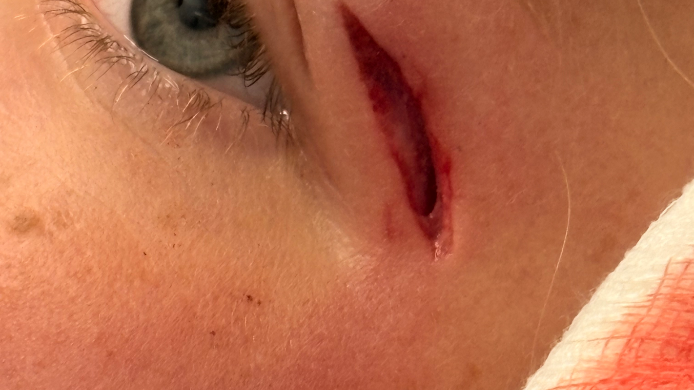 Liam’s eye
