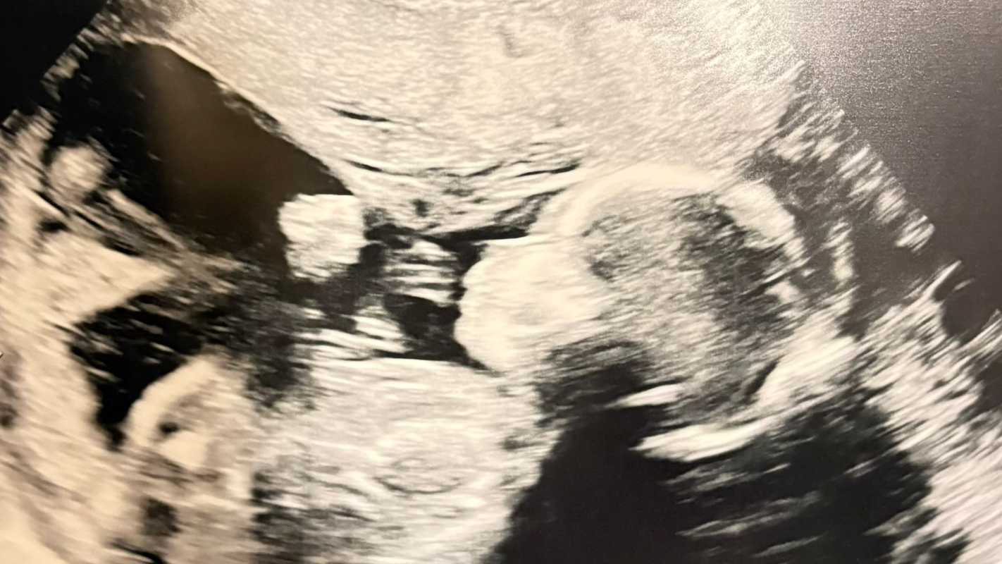 High Risk Pregnancy Triplets