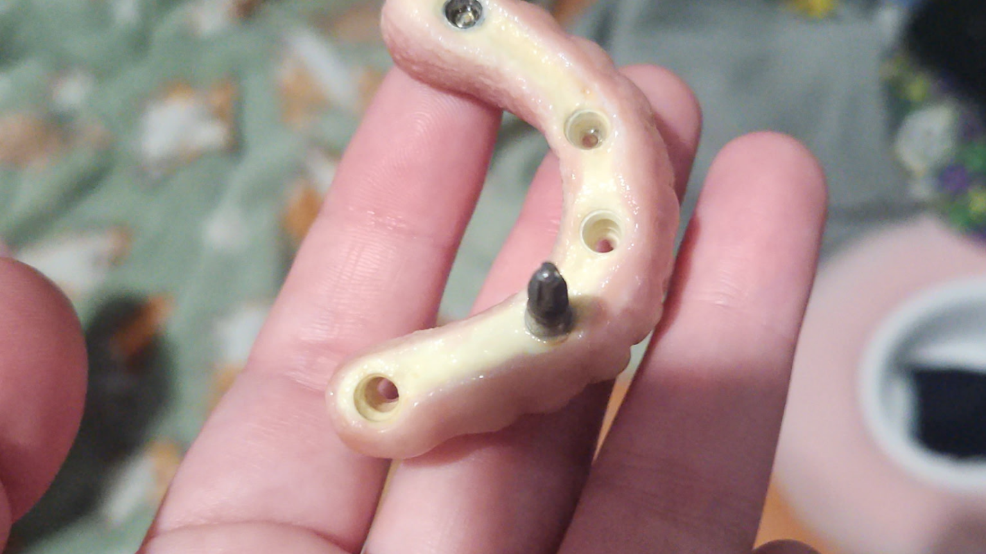 Reconstruction of failed implants