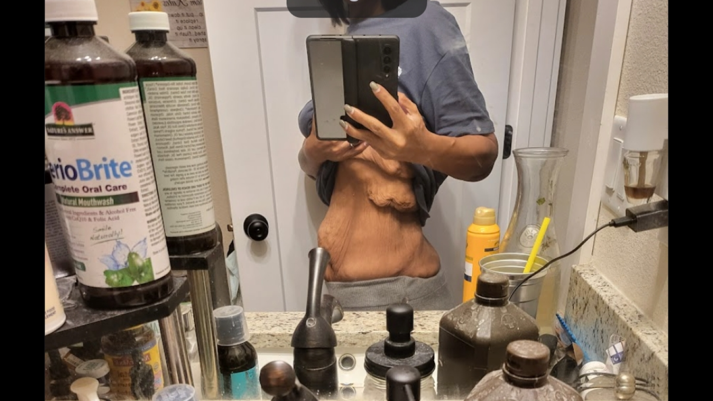 Skin removal surgery