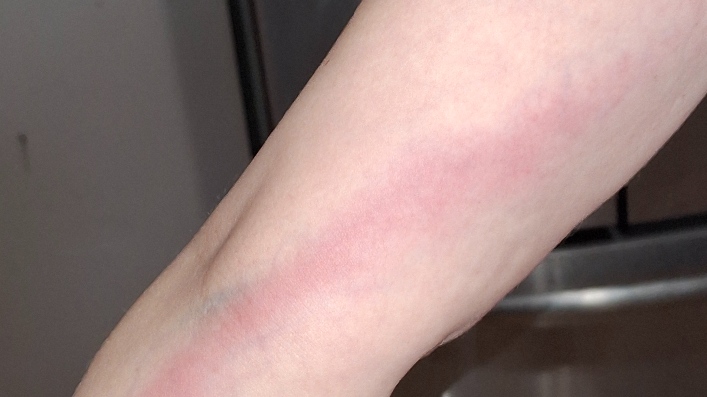 Lymphatic Therapy Expenses